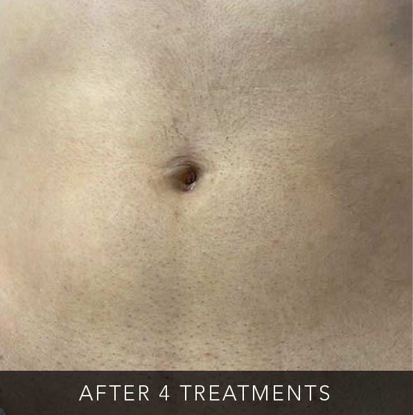 After-body