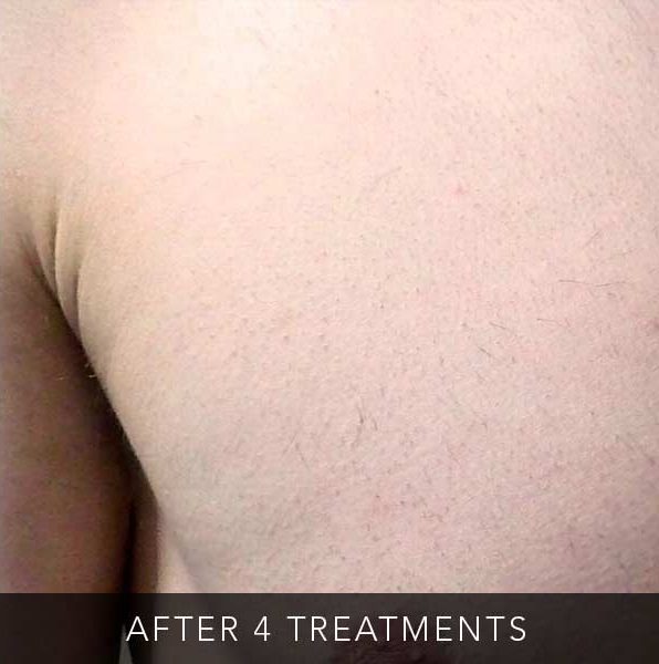 After-facethree