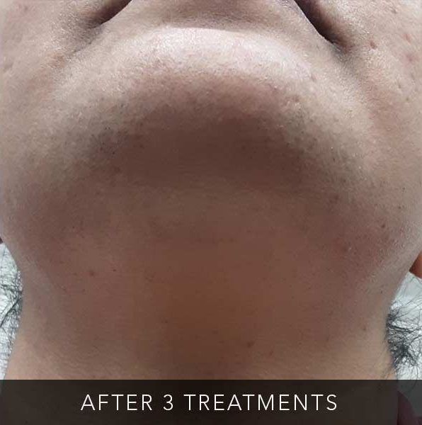 After-facefour