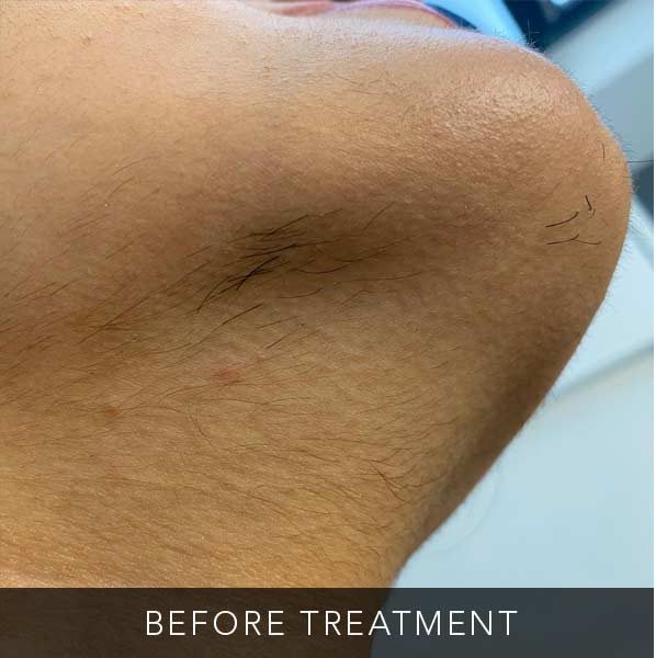 Before-facefour
